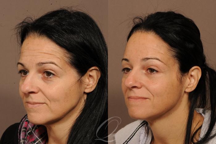 Brow Lift Case 292 Before & After View #2 | Serving Rochester, Syracuse & Buffalo, NY | Quatela Center for Plastic Surgery