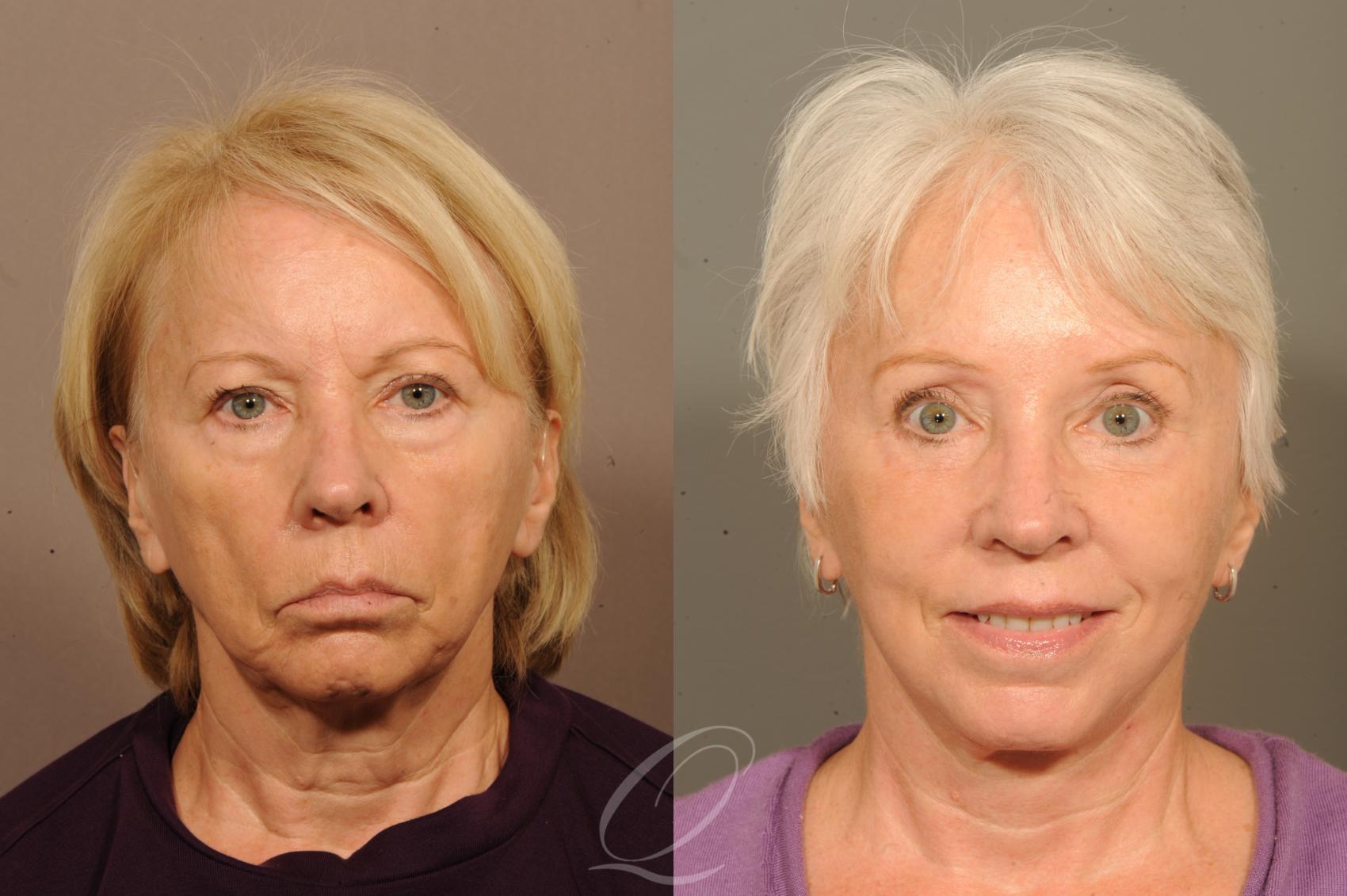 Skin Resurfacing Case 303 Before & After View #1 | Serving Rochester, Syracuse & Buffalo, NY | Quatela Center for Plastic Surgery
