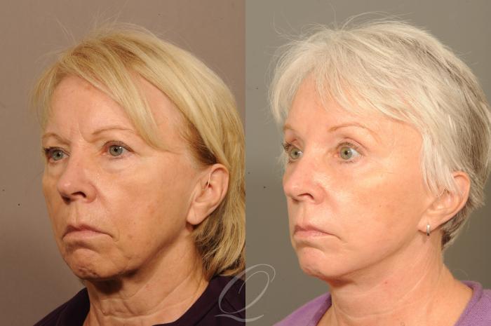 Eyelid Lift Case 303 Before & After View #2 | Serving Rochester, Syracuse & Buffalo, NY | Quatela Center for Plastic Surgery