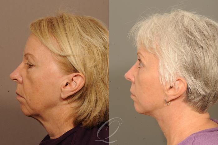 Skin Resurfacing Case 303 Before & After View #3 | Serving Rochester, Syracuse & Buffalo, NY | Quatela Center for Plastic Surgery