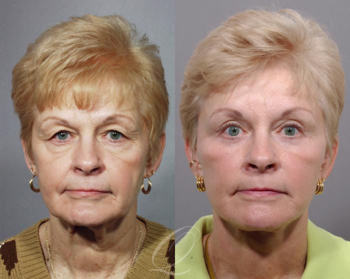 Brow Lift Case 69 Before & After View #1 | Serving Rochester, Syracuse & Buffalo, NY | Quatela Center for Plastic Surgery