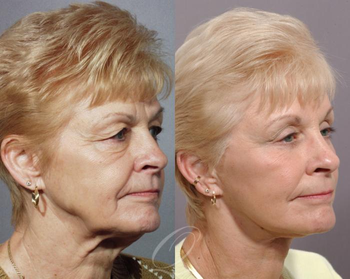 Brow Lift Case 69 Before & After View #2 | Serving Rochester, Syracuse & Buffalo, NY | Quatela Center for Plastic Surgery