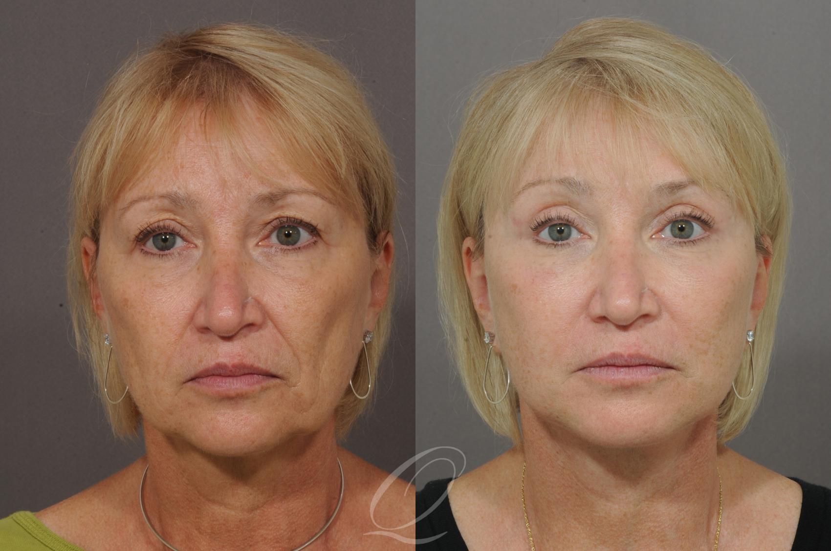 Brow Lift Case 70 Before & After View #1 | Serving Rochester, Syracuse & Buffalo, NY | Quatela Center for Plastic Surgery