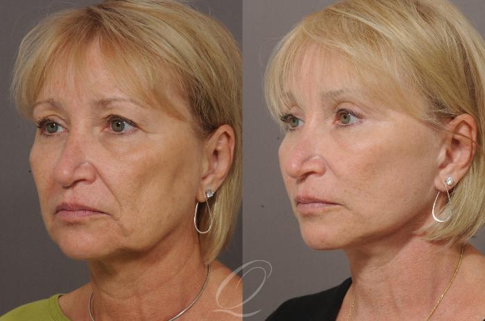 Brow Lift Case 70 Before & After View #2 | Serving Rochester, Syracuse & Buffalo, NY | Quatela Center for Plastic Surgery