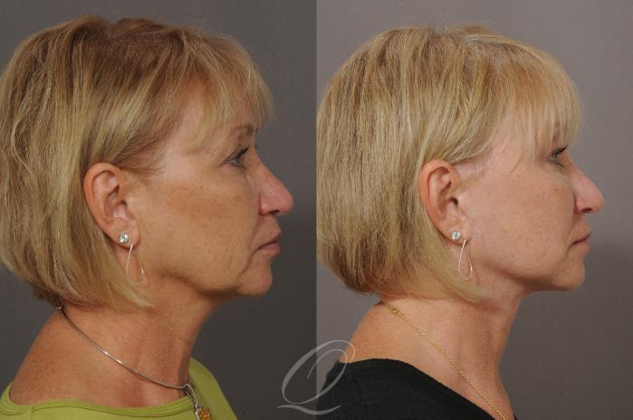 Brow Lift Case 70 Before & After View #3 | Serving Rochester, Syracuse & Buffalo, NY | Quatela Center for Plastic Surgery