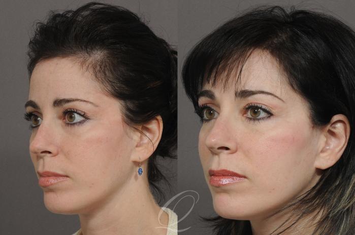 Brow Lift Case 71 Before & After View #2 | Serving Rochester, Syracuse & Buffalo, NY | Quatela Center for Plastic Surgery
