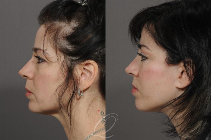 Brow Lift Case 71 Before & After View #3 | Serving Rochester, Syracuse & Buffalo, NY | Quatela Center for Plastic Surgery