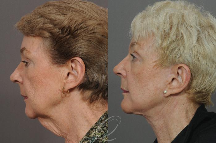 Brow Lift Case 72 Before & After View #2 | Serving Rochester, Syracuse & Buffalo, NY | Quatela Center for Plastic Surgery