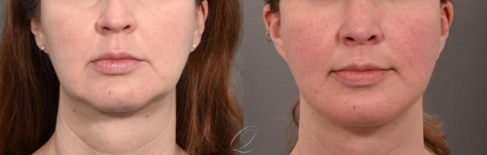 Buccal Fat Removal Case 1001590 Before & After Front | Serving Rochester, Syracuse & Buffalo, NY | Quatela Center for Plastic Surgery