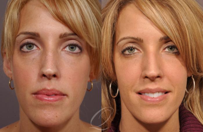 Cheek Augmentation Case 208 Before & After View #1 | Serving Rochester, Syracuse & Buffalo, NY | Quatela Center for Plastic Surgery