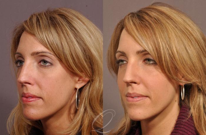 Cheek Augmentation Case 208 Before & After View #2 | Serving Rochester, Syracuse & Buffalo, NY | Quatela Center for Plastic Surgery
