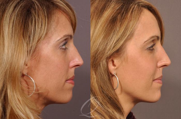 Cheek Augmentation Case 208 Before & After View #3 | Serving Rochester, Syracuse & Buffalo, NY | Quatela Center for Plastic Surgery