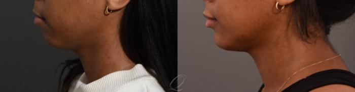 Chin Augmentation Case 1001564 Before & After Left Side | Serving Rochester, Syracuse & Buffalo, NY | Quatela Center for Plastic Surgery