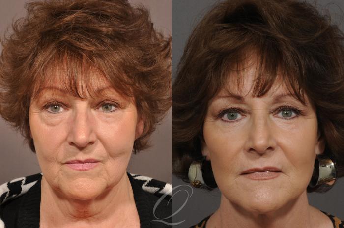 Chin Augmentation Case 28 Before & After View #1 | Serving Rochester, Syracuse & Buffalo, NY | Quatela Center for Plastic Surgery