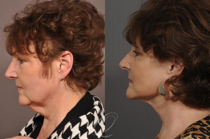Chin Augmentation Case 28 Before & After View #3 | Serving Rochester, Syracuse & Buffalo, NY | Quatela Center for Plastic Surgery