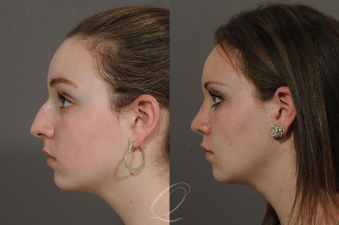 Chin Augmentation Case 45 Before & After View #3 | Serving Rochester, Syracuse & Buffalo, NY | Quatela Center for Plastic Surgery