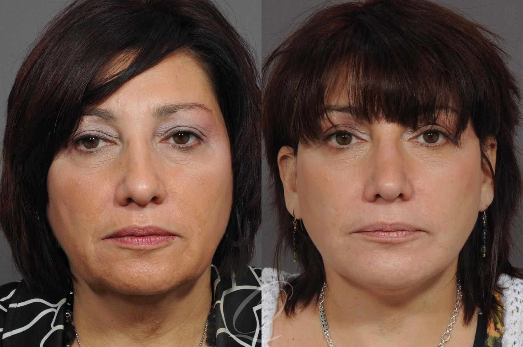 Chin Augmentation Case 55 Before & After View #1 | Serving Rochester, Syracuse & Buffalo, NY | Quatela Center for Plastic Surgery