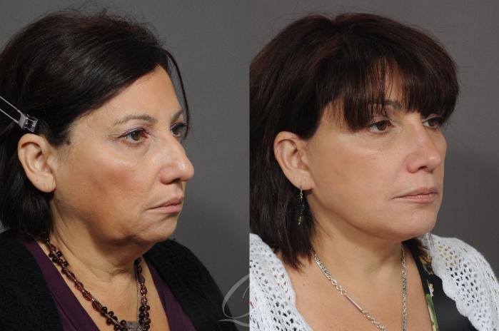 Chin Augmentation Case 55 Before & After View #2 | Serving Rochester, Syracuse & Buffalo, NY | Quatela Center for Plastic Surgery