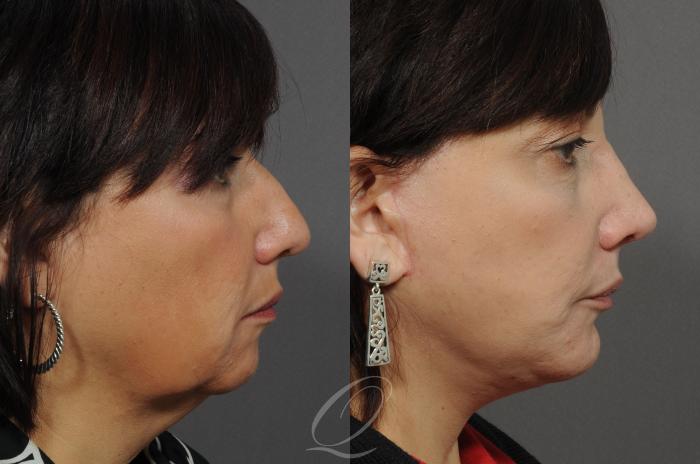 Chin Augmentation Case 55 Before & After View #3 | Serving Rochester, Syracuse & Buffalo, NY | Quatela Center for Plastic Surgery