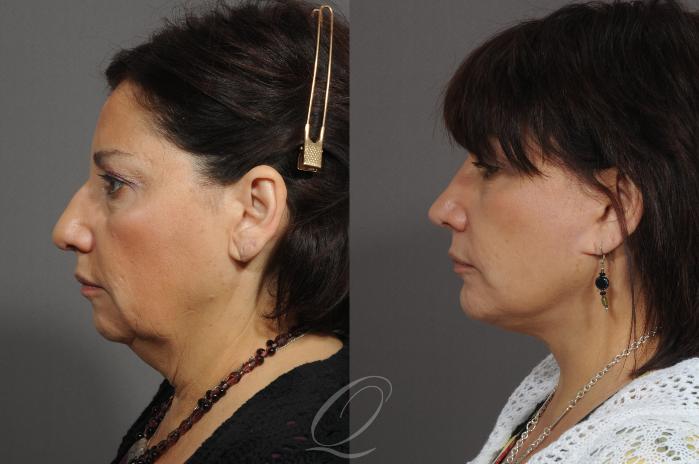 Chin Augmentation Case 55 Before & After View #4 | Serving Rochester, Syracuse & Buffalo, NY | Quatela Center for Plastic Surgery