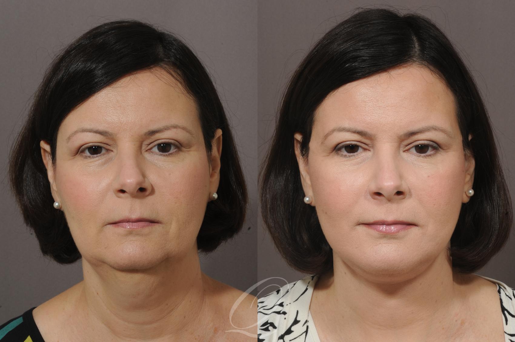 Chin Augmentation Case 57 Before & After View #1 | Serving Rochester, Syracuse & Buffalo, NY | Quatela Center for Plastic Surgery
