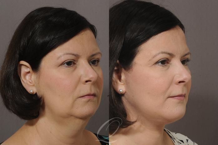 Chin Augmentation Case 57 Before & After View #2 | Serving Rochester, Syracuse & Buffalo, NY | Quatela Center for Plastic Surgery