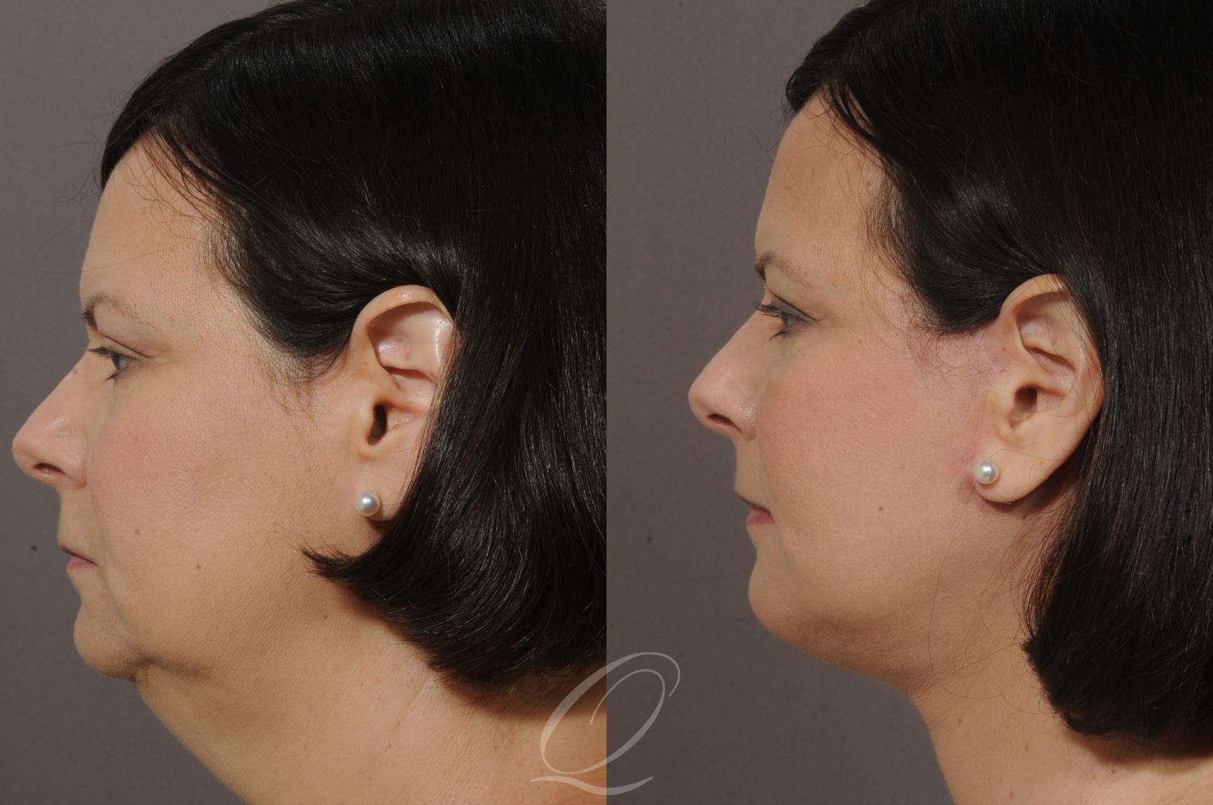 Chin Augmentation Case 57 Before & After View #3 | Serving Rochester, Syracuse & Buffalo, NY | Quatela Center for Plastic Surgery
