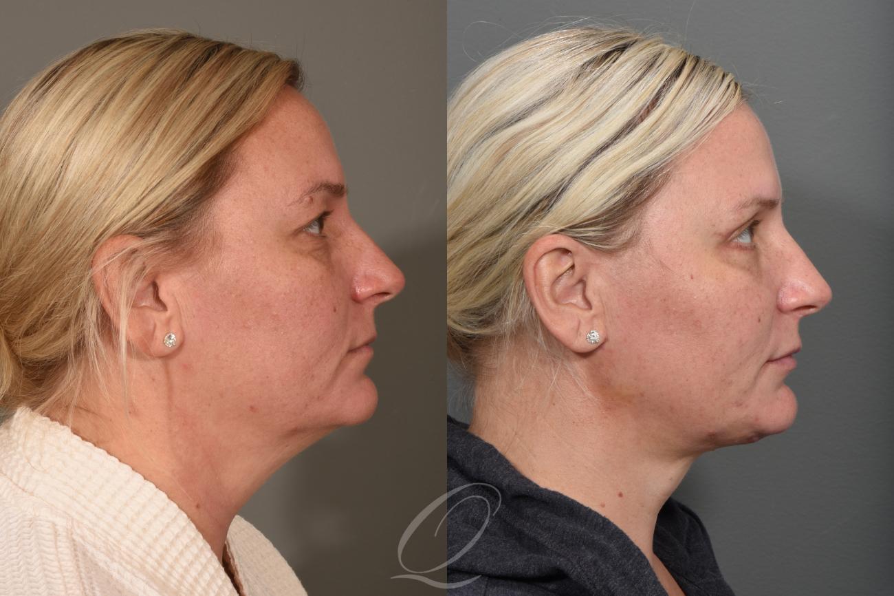 Deep Neck Contouring Case 1001353 Before & After Right Side | Serving Rochester, Syracuse & Buffalo, NY | Quatela Center for Plastic Surgery