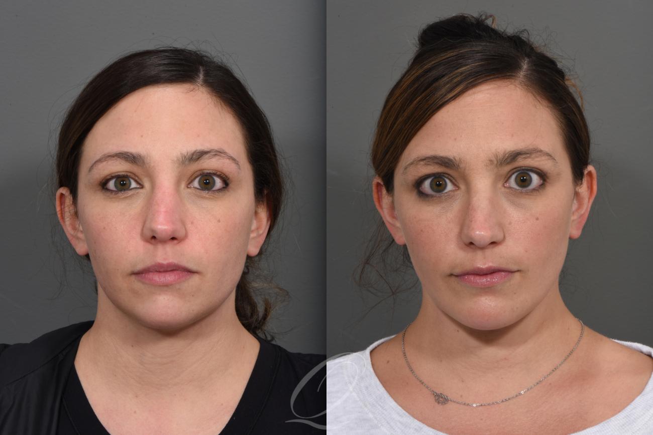 Deep Neck Contouring Before & After Photo Gallery Serving Rochester