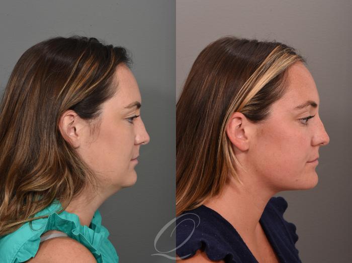 Deep Neck Contouring Case 1001510 Before & After Right Side | Serving Rochester, Syracuse & Buffalo, NY | Quatela Center for Plastic Surgery