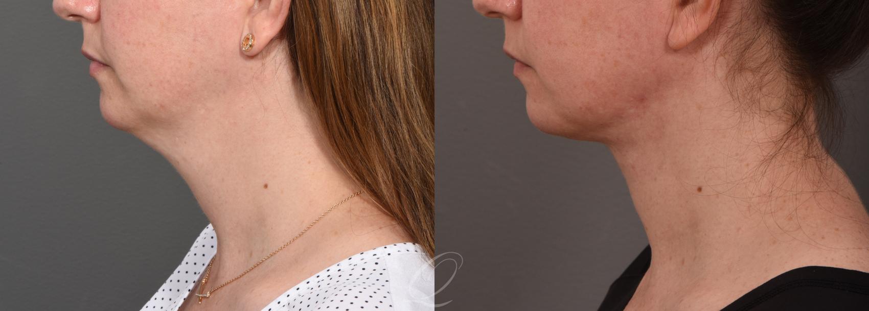 Deep Neck Contouring Case 1001513 Before & After Left Side | Serving Rochester, Syracuse & Buffalo, NY | Quatela Center for Plastic Surgery