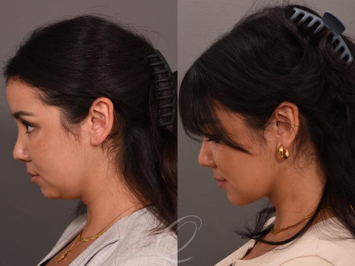Deep Neck Contouring Case 1001548 Before & After Left Side | Serving Rochester, Syracuse & Buffalo, NY | Quatela Center for Plastic Surgery