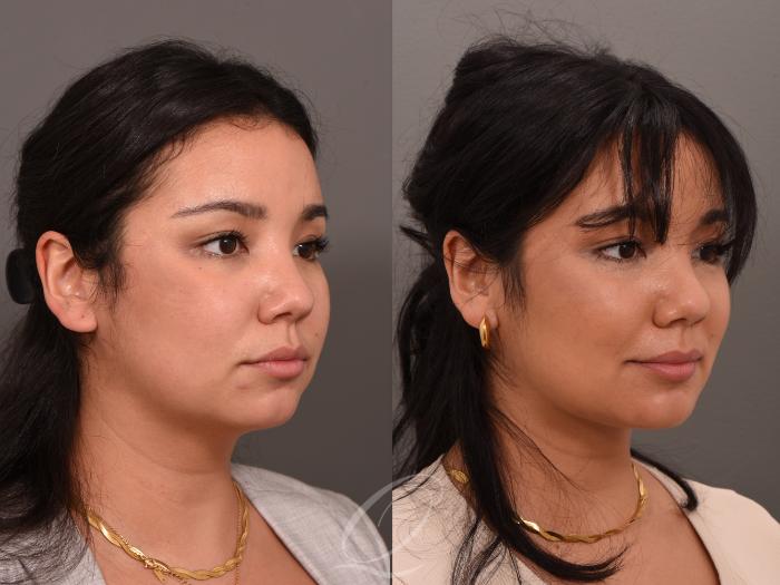 Chin Augmentation Case 1001548 Before & After Right Oblique | Serving Rochester, Syracuse & Buffalo, NY | Quatela Center for Plastic Surgery