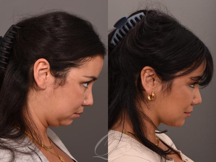 Deep Neck Contouring Case 1001548 Before & After Right Side | Serving Rochester, Syracuse & Buffalo, NY | Quatela Center for Plastic Surgery