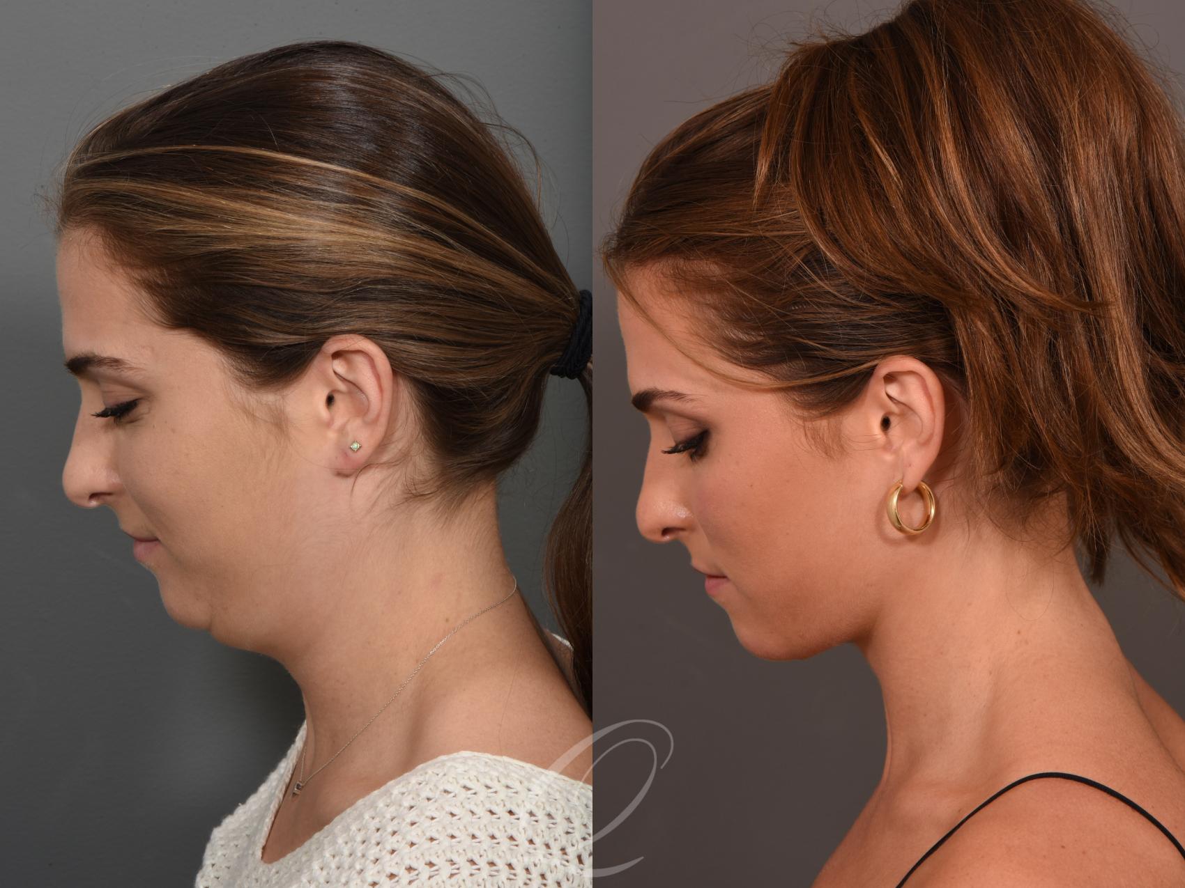 Deep Neck Contouring Case 1001549 Before & After Left Side | Serving Rochester, Syracuse & Buffalo, NY | Quatela Center for Plastic Surgery