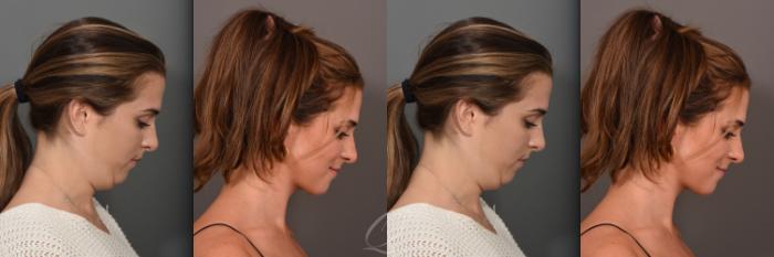 Deep Neck Contouring Case 1001549 Before & After Right Side | Serving Rochester, Syracuse & Buffalo, NY | Quatela Center for Plastic Surgery