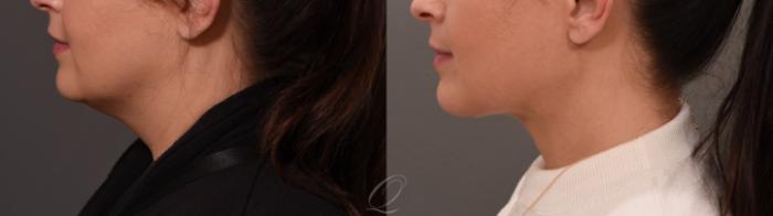 Deep Neck Contouring Case 1001558 Before & After Left Side | Serving Rochester, Syracuse & Buffalo, NY | Quatela Center for Plastic Surgery