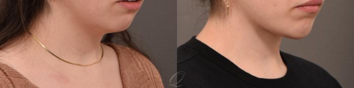Deep Neck Contouring Case 1001634 Before & After Right Oblique | Serving Rochester, Syracuse & Buffalo, NY | Quatela Center for Plastic Surgery