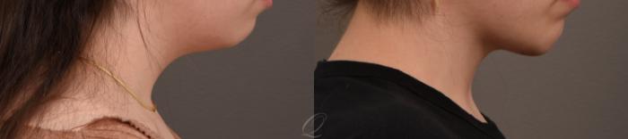 Chin Augmentation Case 1001634 Before & After Right Side | Serving Rochester, Syracuse & Buffalo, NY | Quatela Center for Plastic Surgery