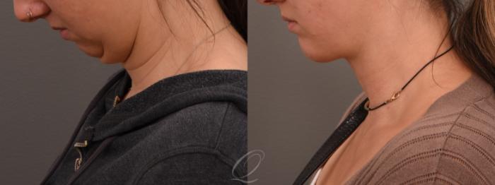 Deep Neck Contouring Case 1001644 Before & After Chin Down | Serving Rochester, Syracuse & Buffalo, NY | Quatela Center for Plastic Surgery