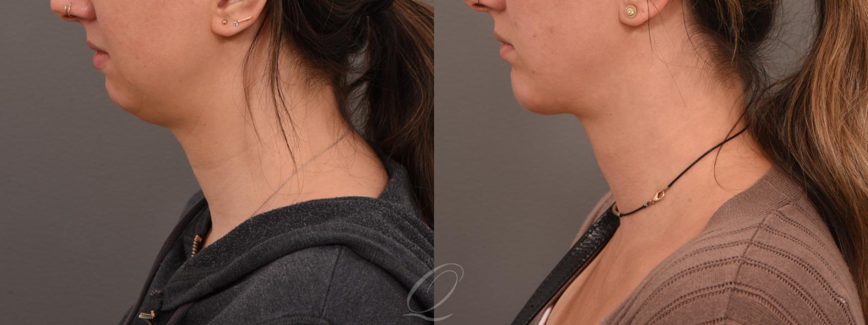 Add Definition to Your Chin and Jawline with Deep Neck Contouring - Quatela  Center for Plastic Surgery