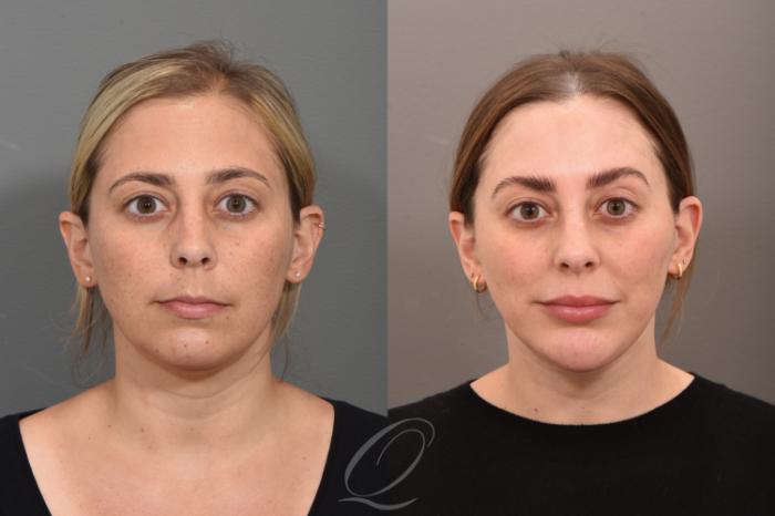 Chin Augmentation Case 1001711 Before & After Front | Serving Rochester, Syracuse & Buffalo, NY | Quatela Center for Plastic Surgery