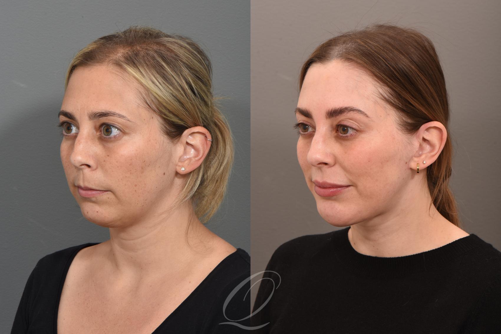 Deep Neck Contouring Case 1001711 Before & After Left Oblique | Serving Rochester, Syracuse & Buffalo, NY | Quatela Center for Plastic Surgery