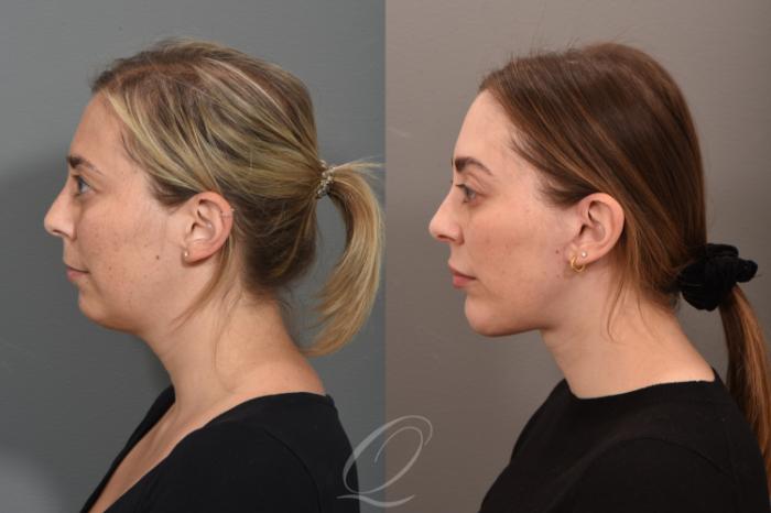 Chin Augmentation Case 1001711 Before & After Left Side | Serving Rochester, Syracuse & Buffalo, NY | Quatela Center for Plastic Surgery