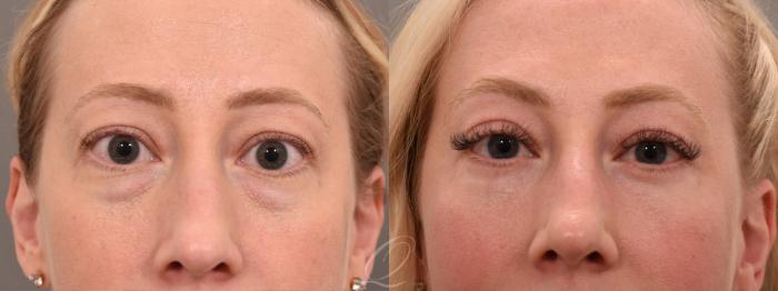 Eyelid Lift Case 1001735 Before & After Close Up | Serving Rochester, Syracuse & Buffalo, NY | Quatela Center for Plastic Surgery