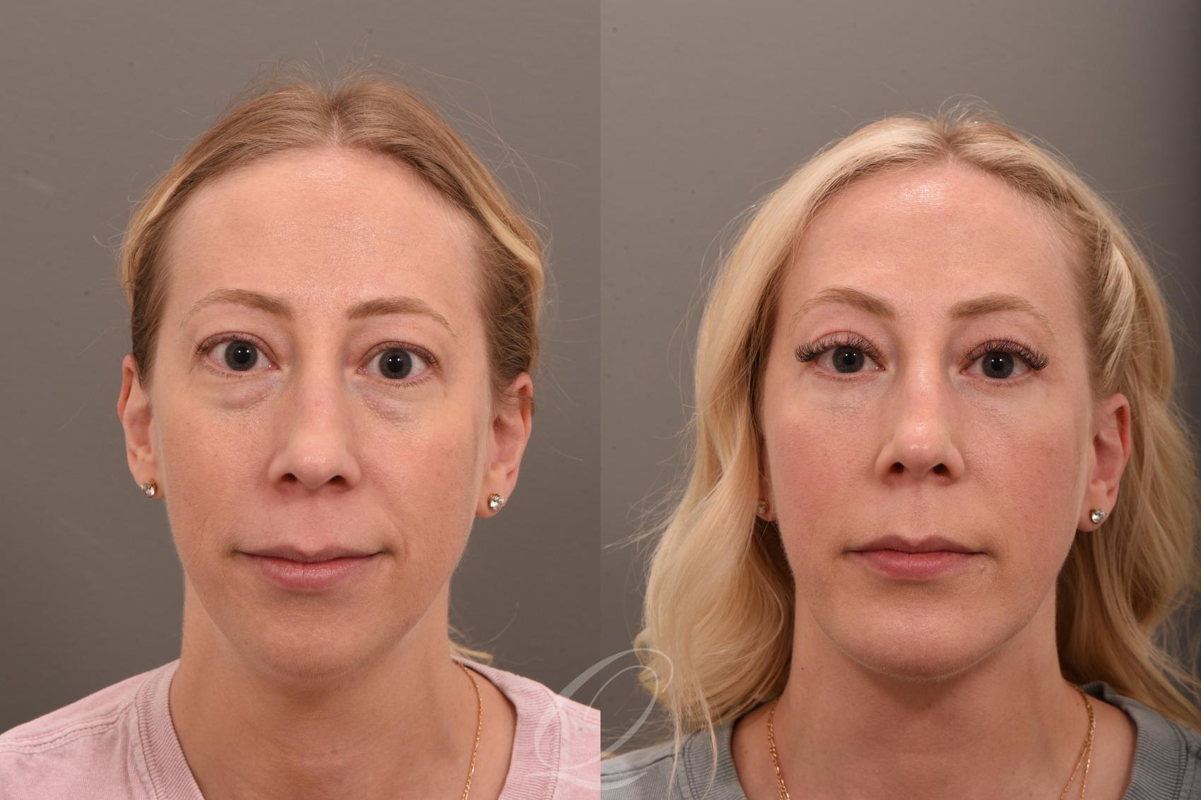 Chin Augmentation Case 1001735 Before & After Front | Serving Rochester, Syracuse & Buffalo, NY | Quatela Center for Plastic Surgery