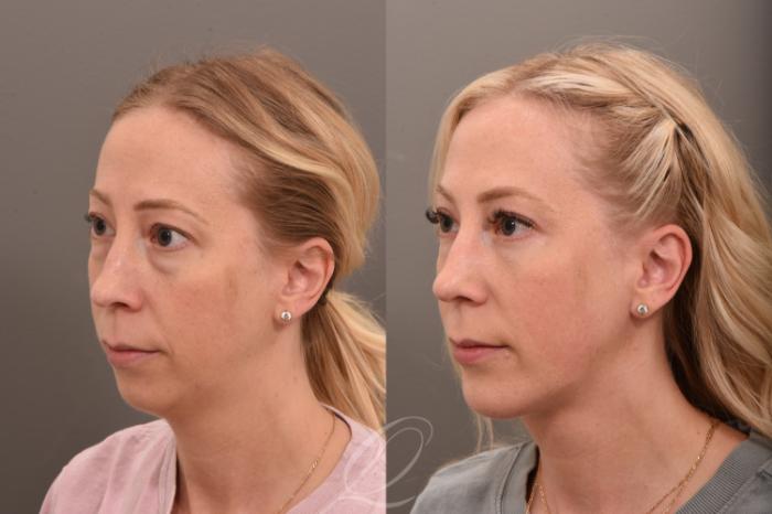 Deep Neck Contouring Case 1001735 Before & After Left Oblique | Serving Rochester, Syracuse & Buffalo, NY | Quatela Center for Plastic Surgery