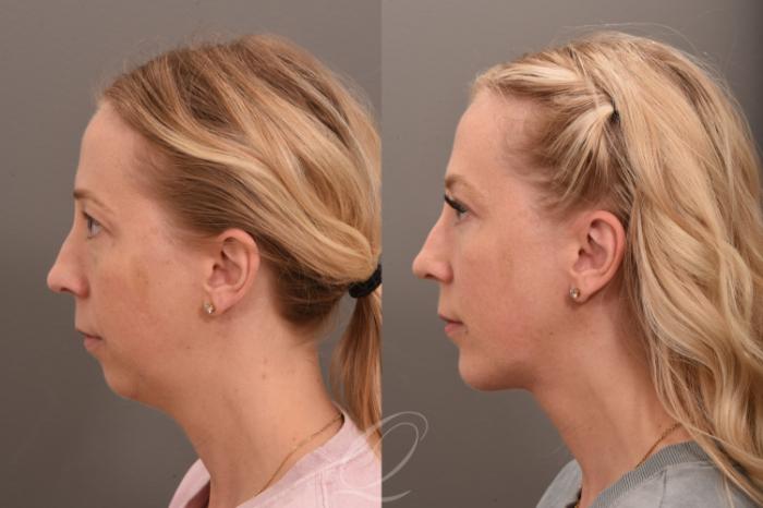 Chin Augmentation Case 1001735 Before & After Left Side | Serving Rochester, Syracuse & Buffalo, NY | Quatela Center for Plastic Surgery