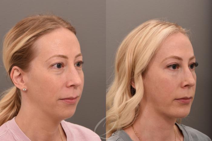 Deep Neck Contouring Case 1001735 Before & After Right Oblique | Serving Rochester, Syracuse & Buffalo, NY | Quatela Center for Plastic Surgery