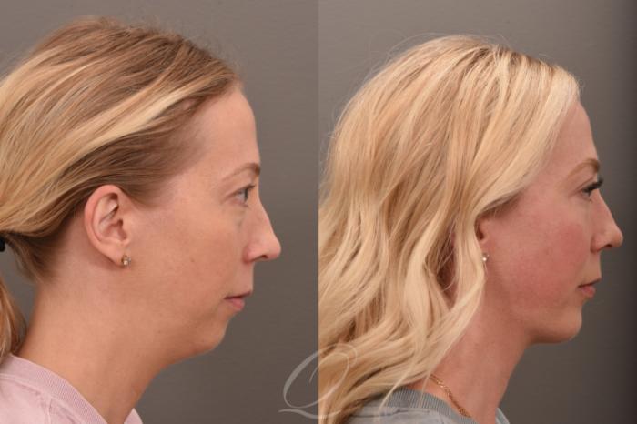 Deep Neck Contouring Case 1001735 Before & After Right Side | Serving Rochester, Syracuse & Buffalo, NY | Quatela Center for Plastic Surgery